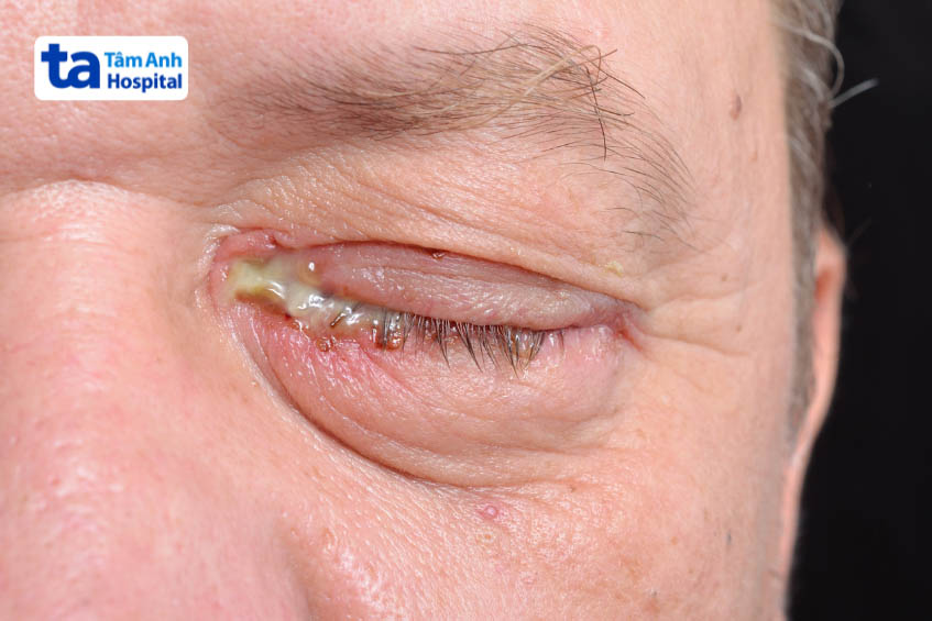 hình ảnh bị bạch hầu ở mắt