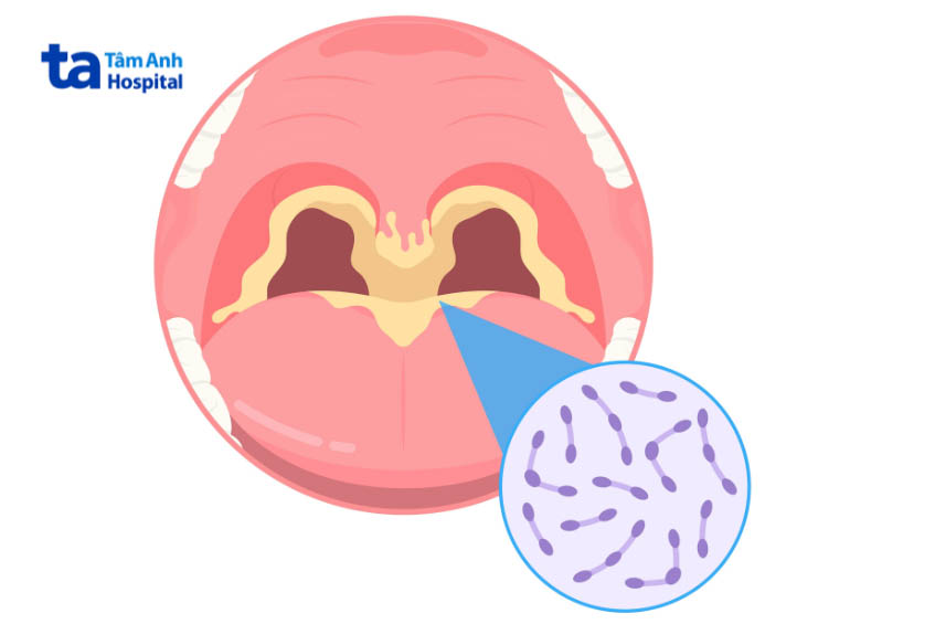 hình ảnh giả mạc mắc bệnh bạch hầu