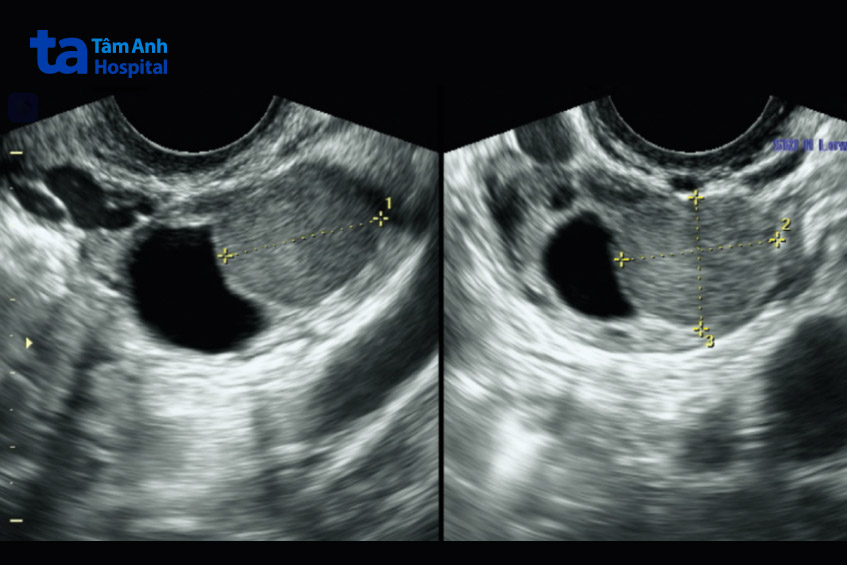 Hình ảnh lạc nội mạc tử cung trên siêu âm (minh họa 1)