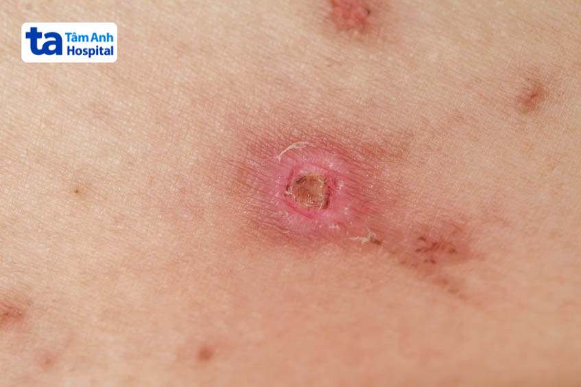 hình ảnh loét da do bạch hầu thể da