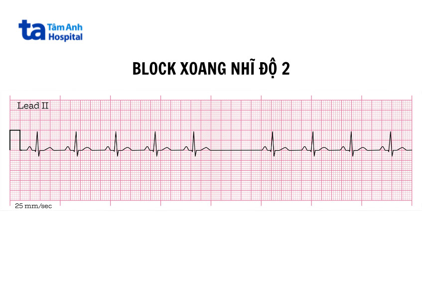 Hình ảnh minh họa block xoang nhĩ độ 2 type 2 trên ECG