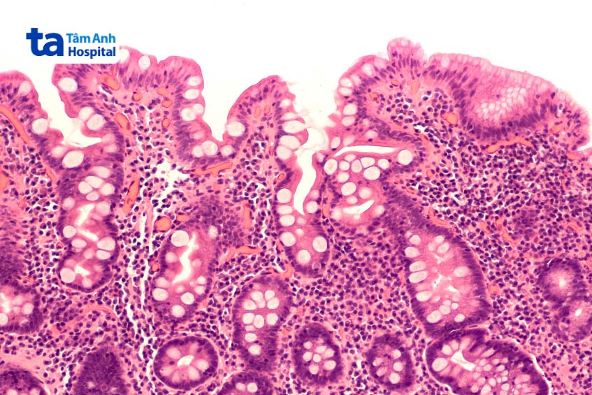 hình ảnh mô bệnh học chuyển sản ruột