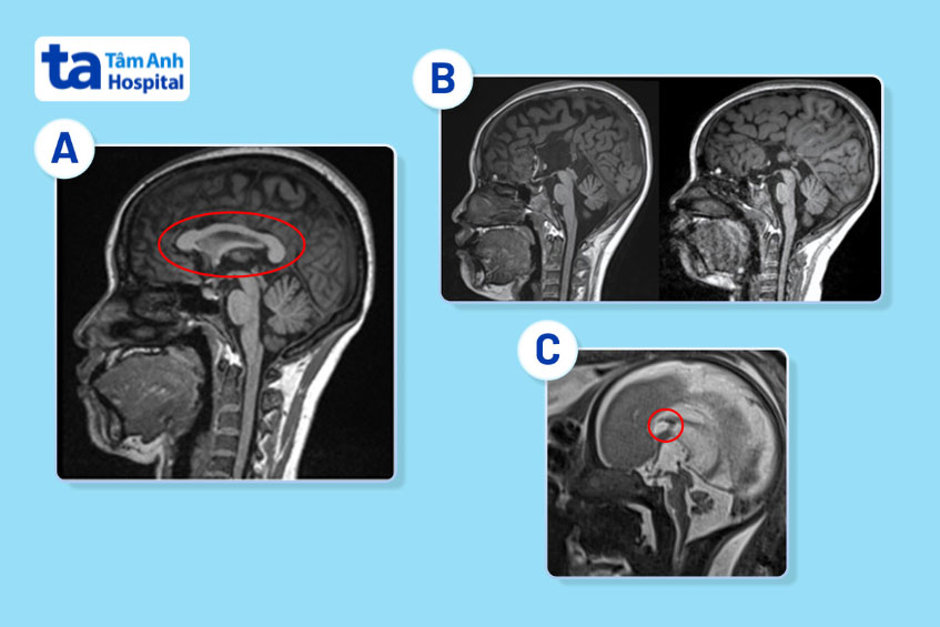 hình ảnh mri của thai nhi