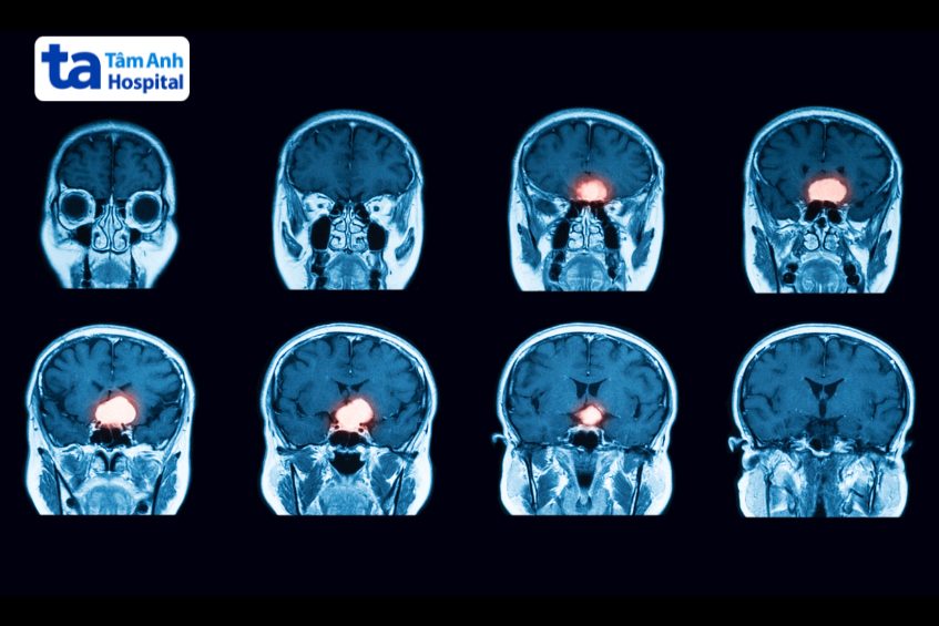 hình ảnh mri tuyến yên