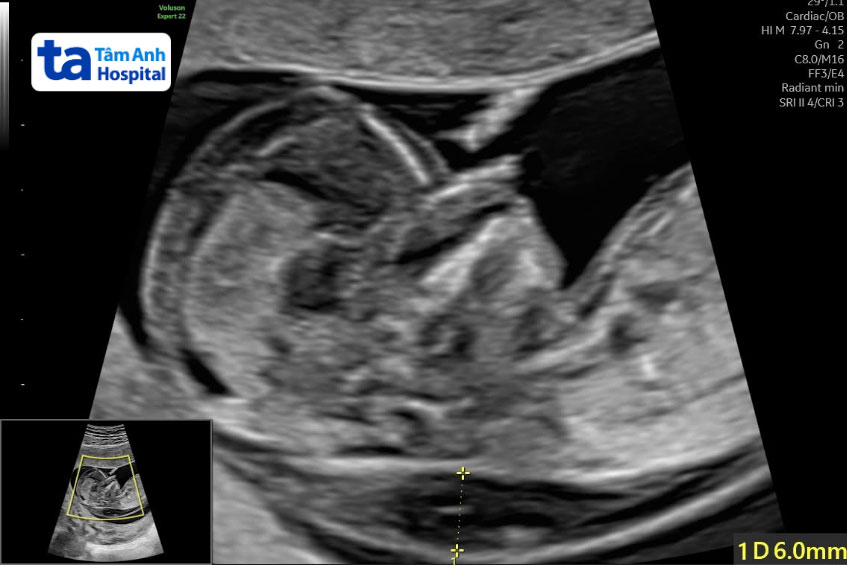 hình ảnh siêu âm tuần 13
