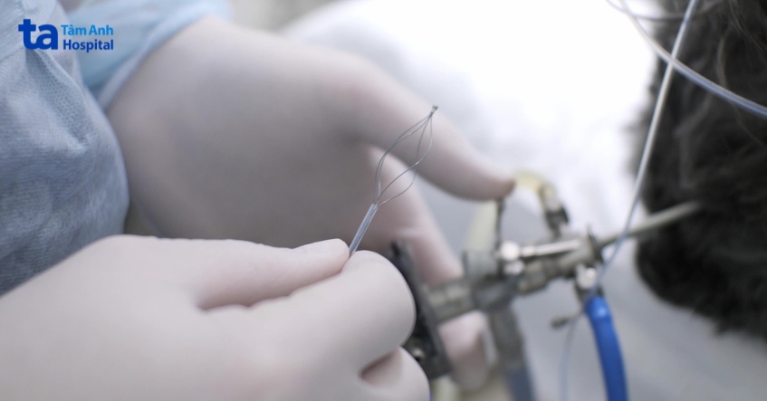 hình ảnh tán sỏi nội soi ngược dòng