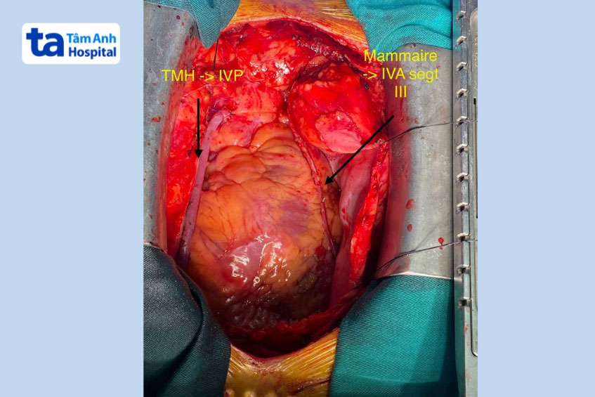 Hình ảnh tim được các bác sĩ thực hiện nối mạch vành