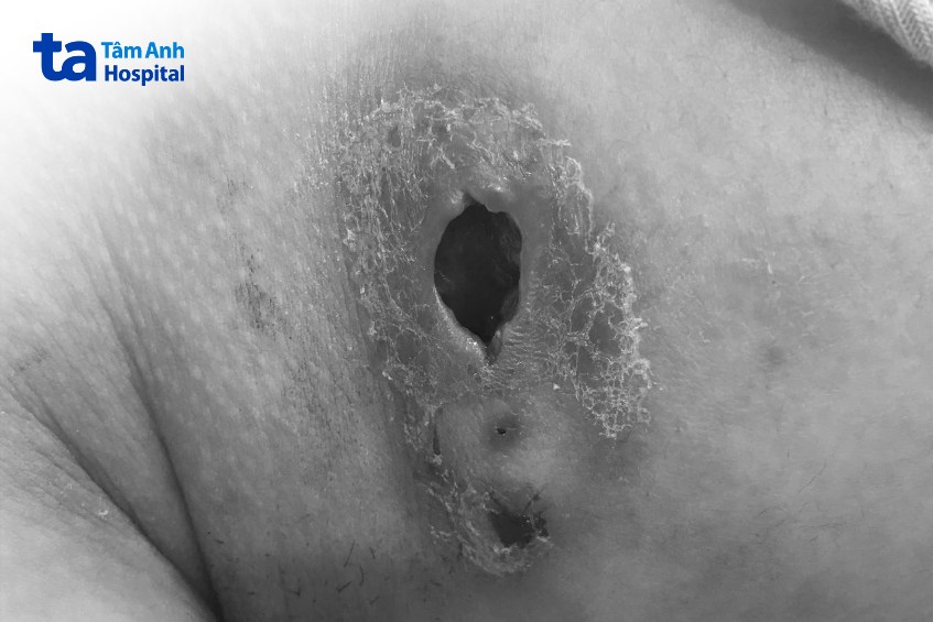 hình ảnh u bã đậu bị vỡ