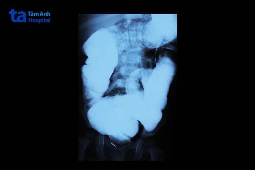 hình ảnh x quang ở bệnh nhi 2 tuổi, mắc bệnh hirschsprung