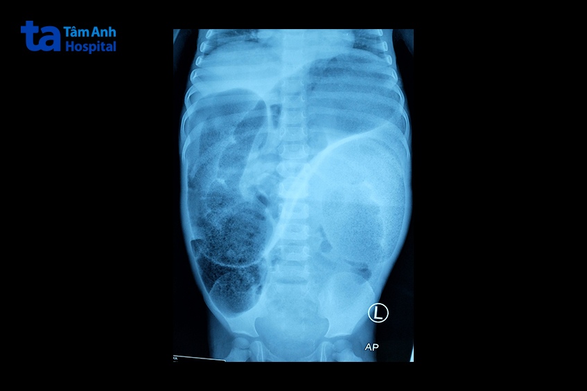 hình ảnh x quang ổ bụng ở trẻ mắc bệnh hirschsprung