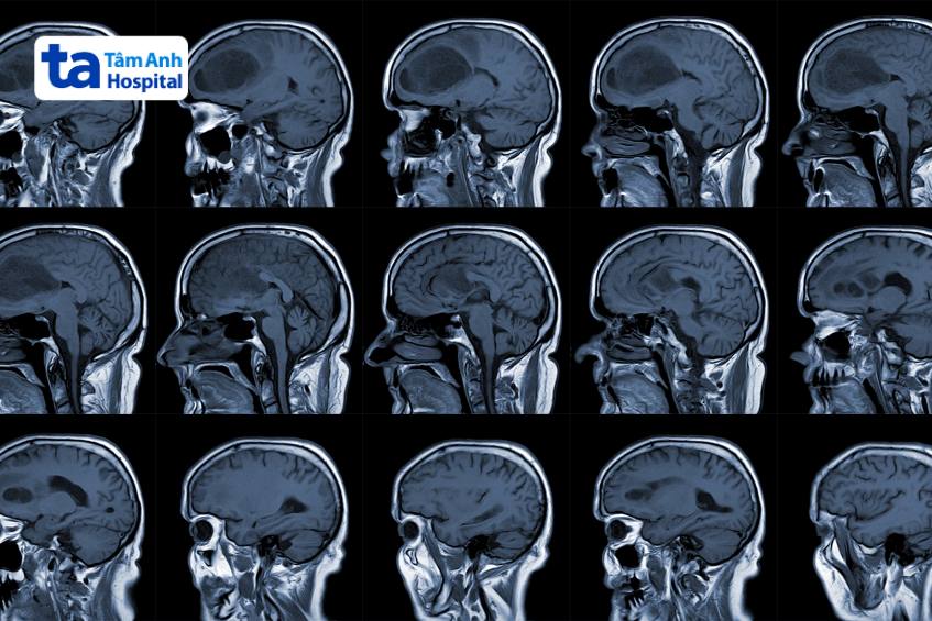hình chụp mri bộ não bị u nguyên bào thần kinh đệm