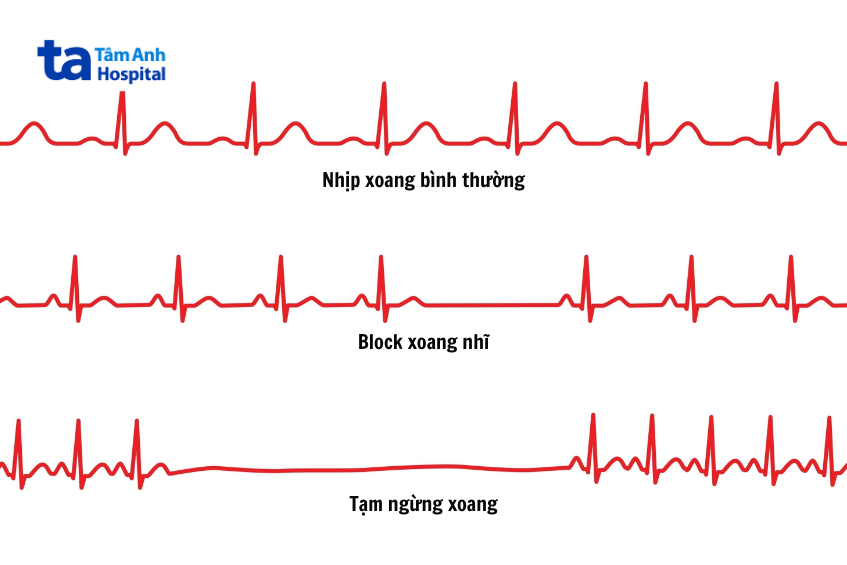 Hình ảnh minh họa các tình trạng block xoang nhĩ trên ECG