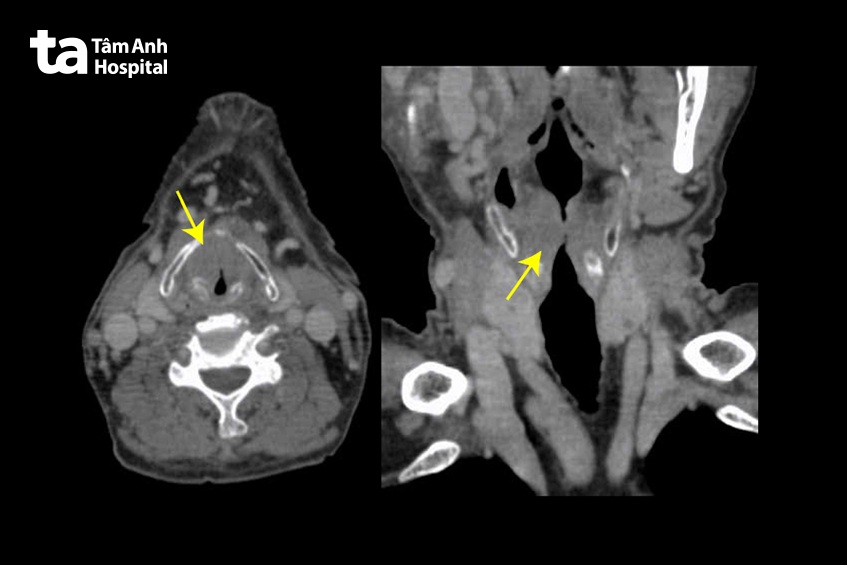 hình u ác tính hẹp lòng thanh quản