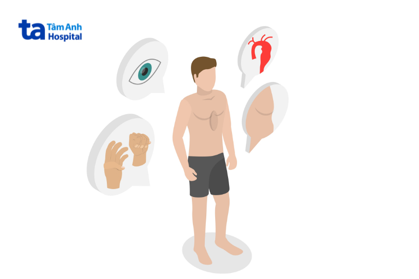 Hội chứng Marfan làm ảnh hưởng đến một số bộ phận trong cơ thể như tim, mắt, mạch máu và xương