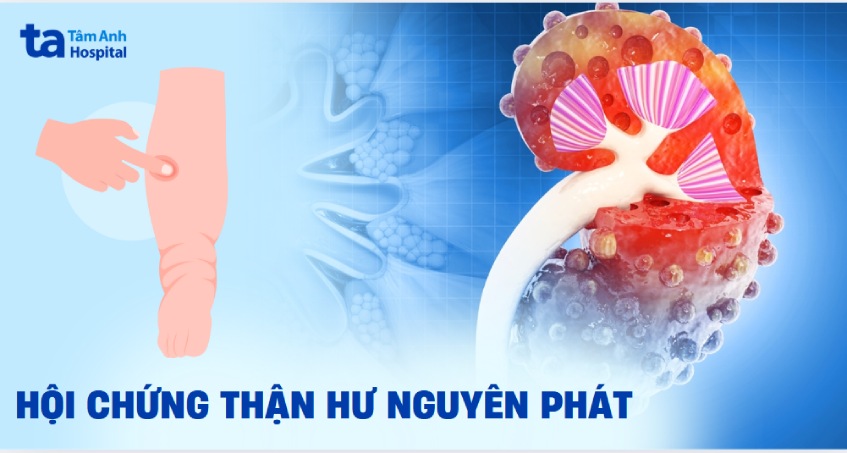hội chứng thận hư nguyên phát