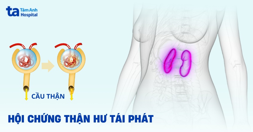 Hội chứng thận hư tái phát: Nguyên nhân, dấu hiệu và cách điều trị