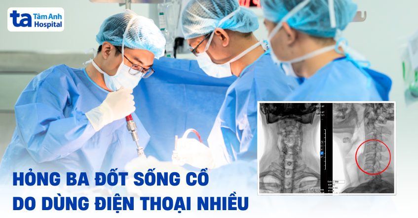 hỏng ba đốt sống cổ do dùng điện thoại