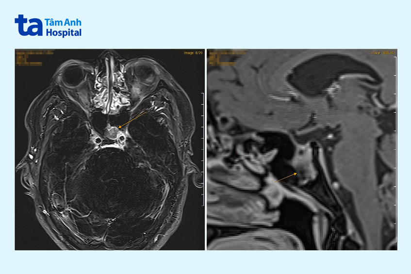 Kết quả chụp cộng hưởng từ MRI ghi nhận người bệnh có khối u não