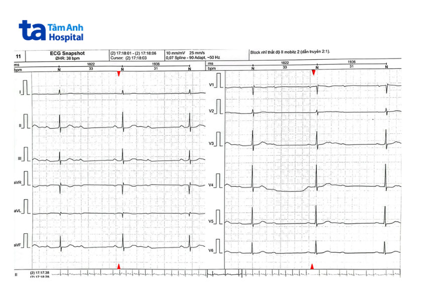 Kết quả điện tâm đồ (ECG) của ông Hoàng cho thấy các xung điện dẫn truyền từ tâm nhĩ qua tâm thất không liên tục