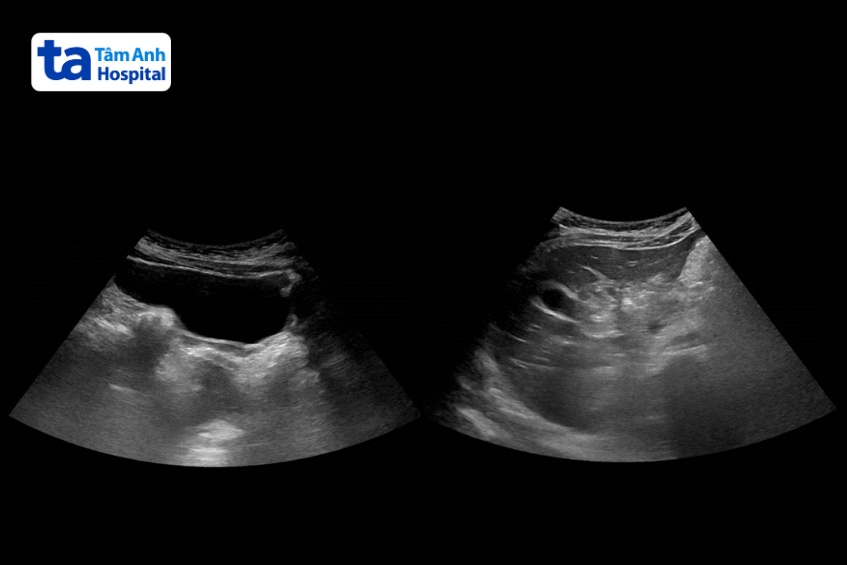 kết quả siêu âm của bệnh nhi cho thấy bụng chướng