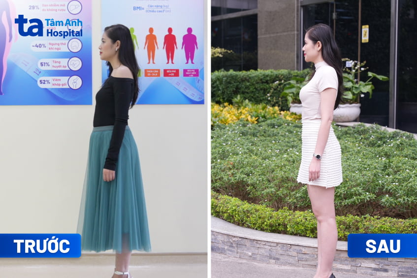 Khách hàng giảm cân thành công tại BVĐK Tâm Anh