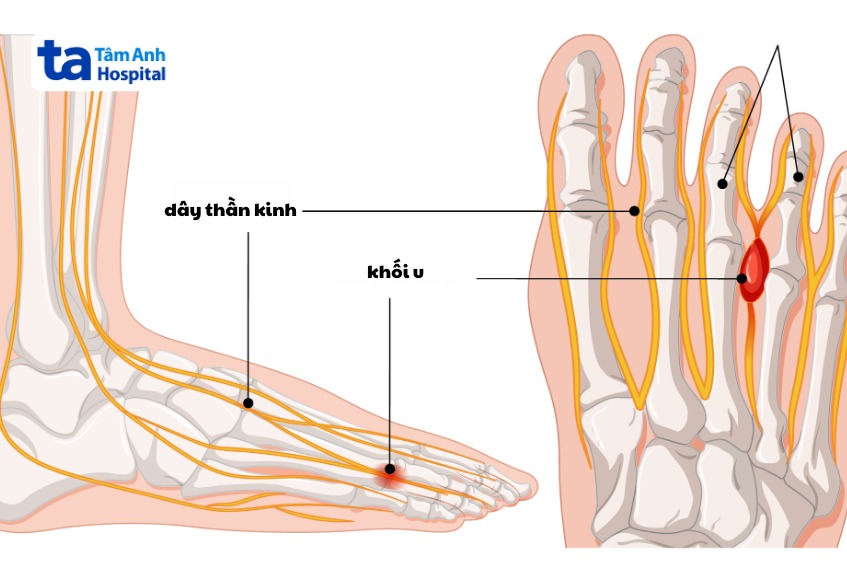 khối u dây thần kinh morton