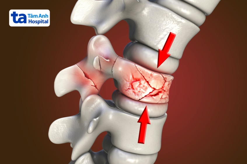 khối u phát triển có thể gây gãy xương