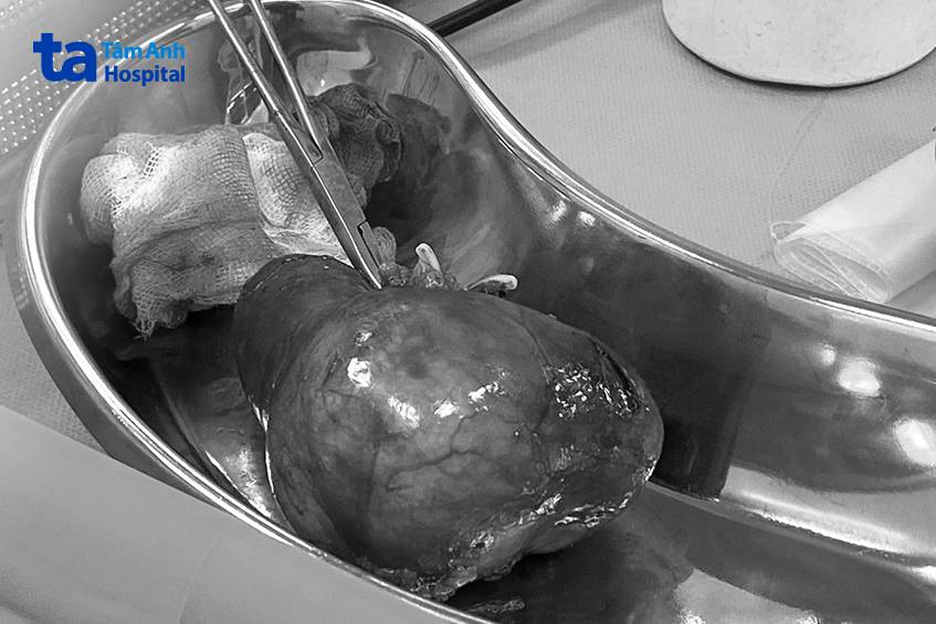 khối u thận phải đường kính 6 cm được đưa ra khỏi cơ thể bà