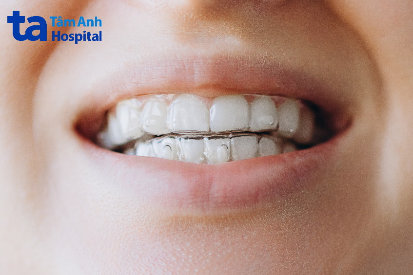 Cách để có khớp cắn đạt đúng chuẩn