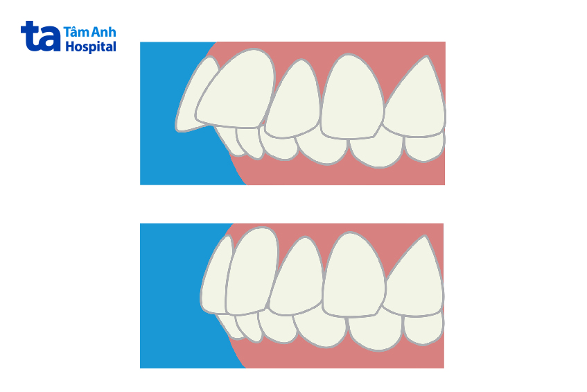 Sai khớp cắn loại 2 là gì?