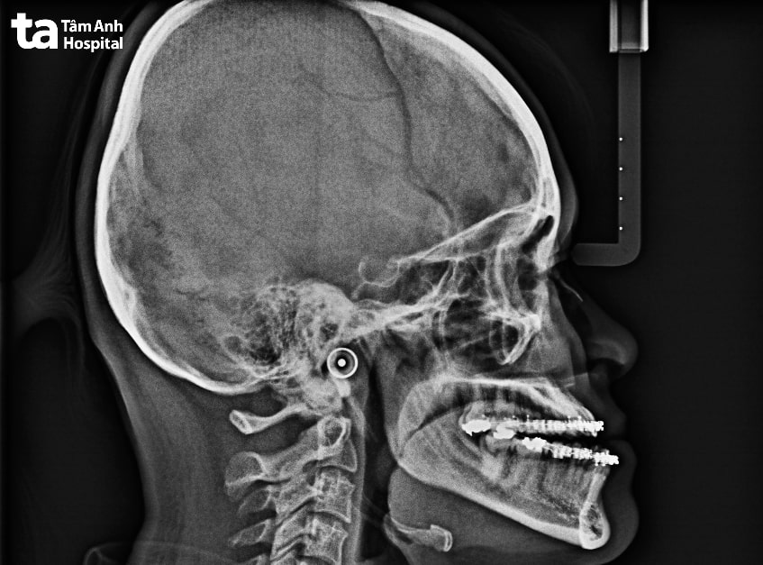 Phân loại sai khớp cắn loại 3