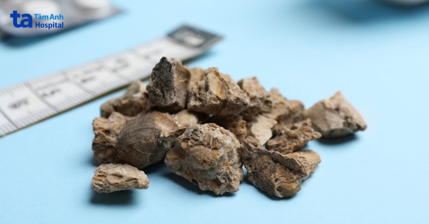 kích thước sỏi niệu quản