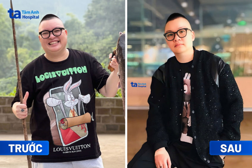 Anh Minh giảm béo thành công tại BVĐK Tâm Anh