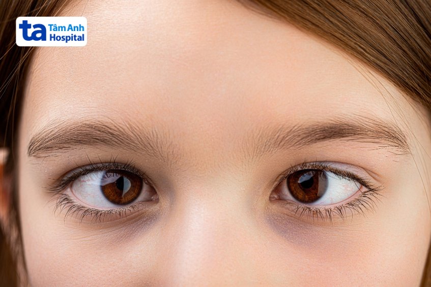 lác mắt do liệt dây thần kinh số 4