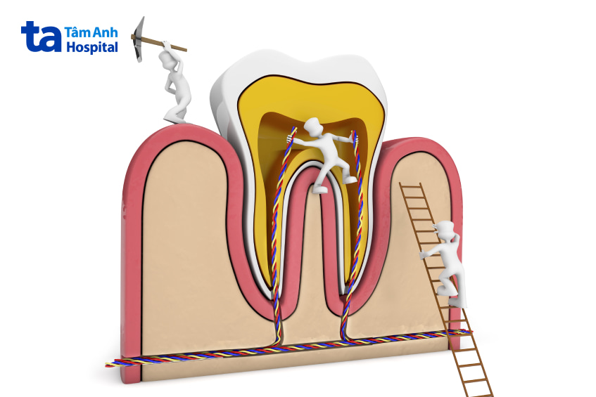 Lấy tủy răng là gì?