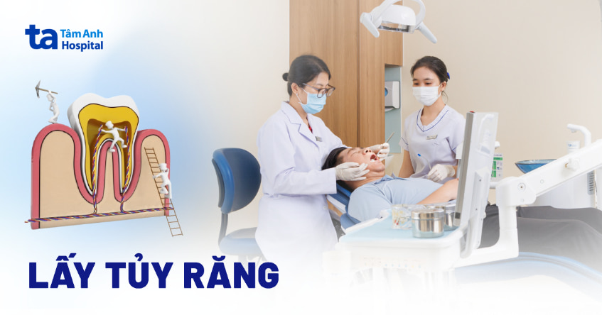Lấy tủy răng là gì? Quy trình và dấu hiệu răng cần lấy tủy