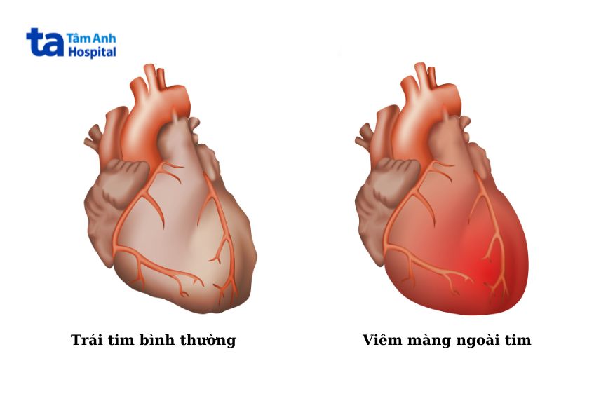Lớp màng bao quanh tim bị viêm sẽ gây triệu chứng đau nhói bên ngực trái