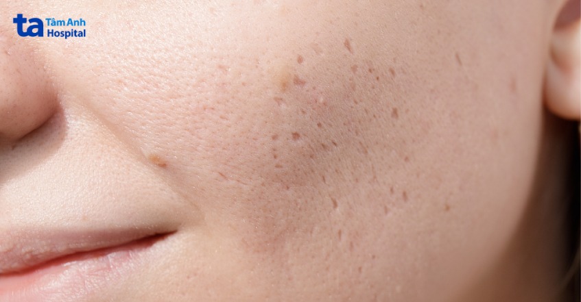 lưu ý khi làm mờ sẹo mụn