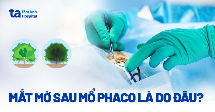 Mắt mờ sau mổ Phaco là do đâu? Làm sao để khắc phục tình trạng này?