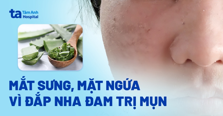 mặt sưng ngứa vì đắp nha đam trị mụn