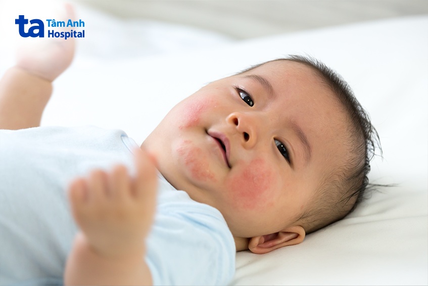 mề đay ở trẻ có thể hình thành do nhiều nguyên nhân