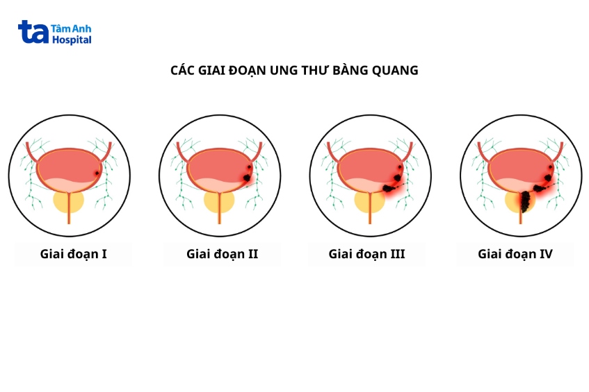 minh họa giai đoạn k bàng quang với ajcc