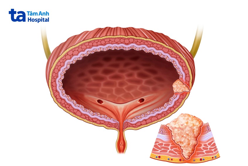 minh họa khối u bàng quang xâm lấn