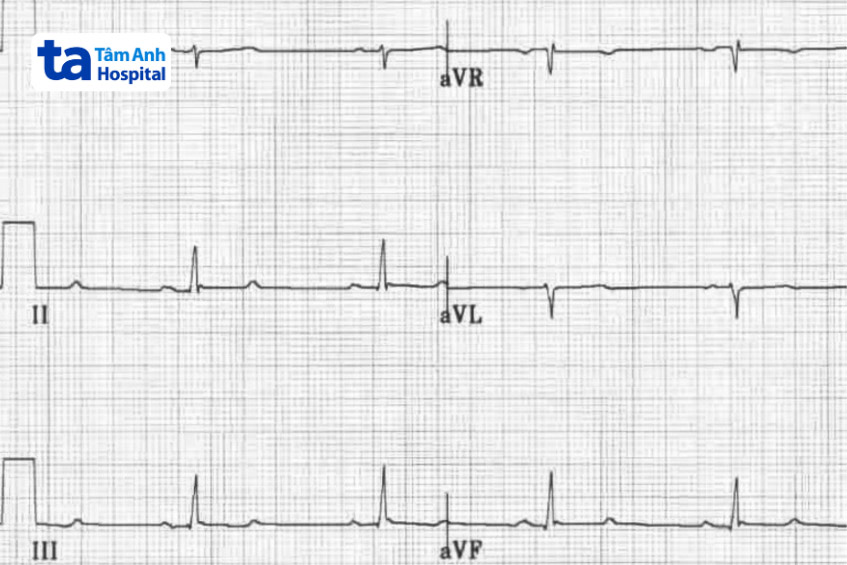 Minh họa tiêu chuẩn chẩn đoán block phân nhánh trái sau trên ECG