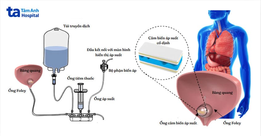 mô hình đo áp lực bàng quang với ống thông foley