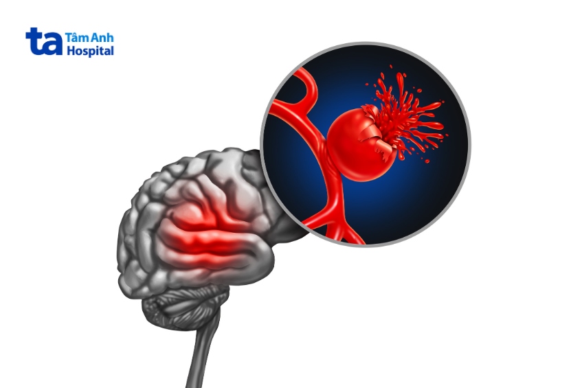 mô phỏng đột quỵ xuất huyết não