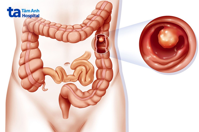 mô phỏng polyp xuất hiện ở đại trực tràng
