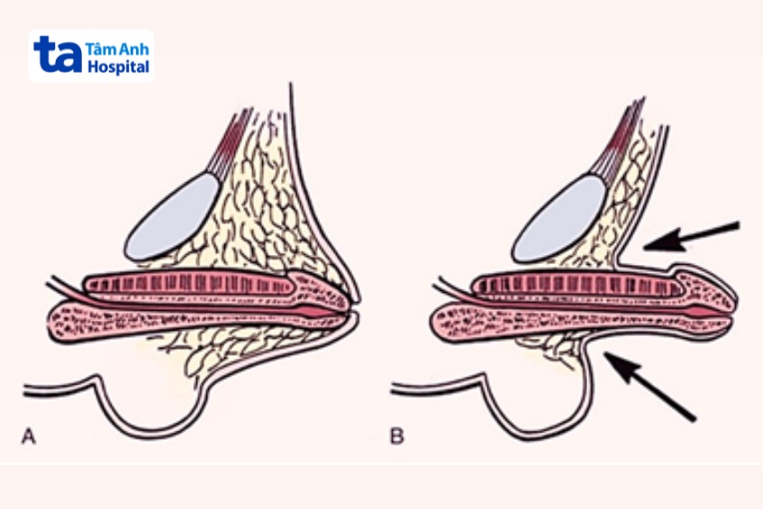 mỡ tích tụ nhiều ở phần mu khiến dương vật bị lún vào trong