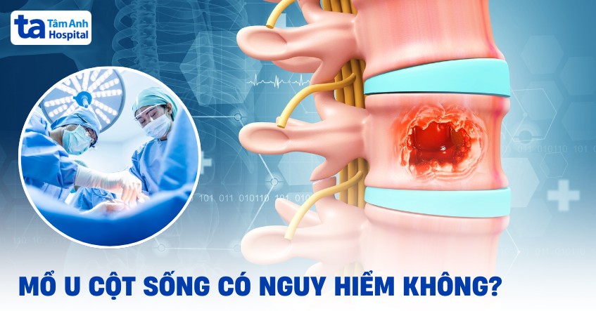 Mổ u cột sống có nguy hiểm không? Khi nào cần phẫu thuật?