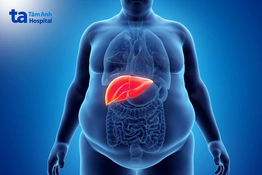 mối liên hệ giữa béo phì và gan nhiễm mỡ
